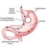 вертикальная гастропластика