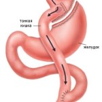 шунтирование желудка